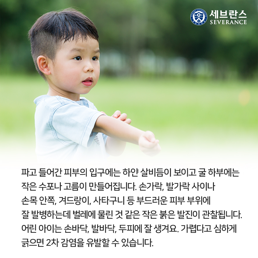 파고 들어간 피부의 입구에는 하얀 살비듬이 보이고 굴 하부에는 작은 수포나 고름이 만들어집니다. 손가락, 발가락 사이나 손목 안쪽, 겨드랑이, 사타구니 등 부드러운 피부 부위에 잘 발병하는데 벌레에 물린 것 같은 작은 붉은 발진이 관찰됩니다. 어린 아이는 손바닥, 발바닥, 두피에 잘 생겨요. 가렵다고 심하게 긁으면 2차 감염을 유발할 수 있습니다.