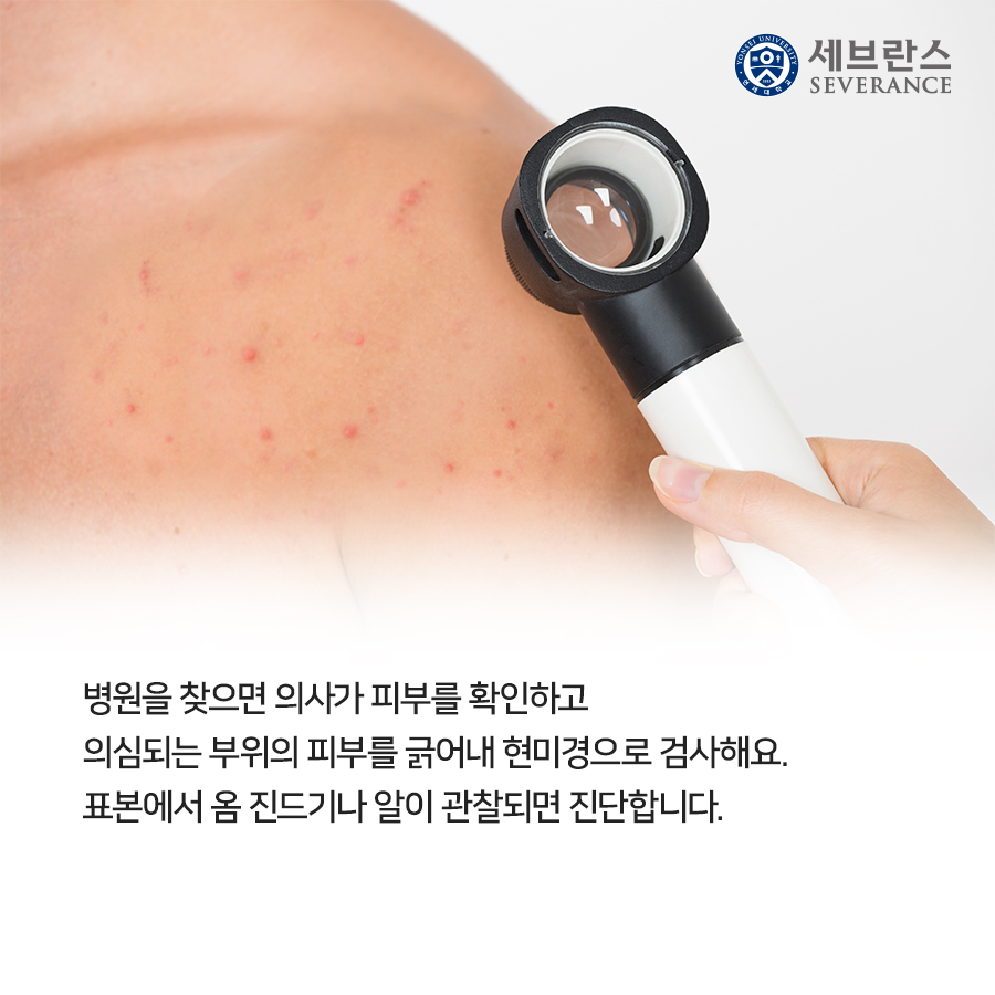 병원을 찾으면 의사가 피부를 확인하고 의심되는 부위의 피부를 긁어내 현미경으로 검사해요. 표본에서 옴 진드기나 알이 관찰되면 진단합니다.